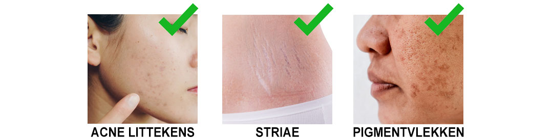 Waarvoor kun je een microneedling behandeling gebruiken