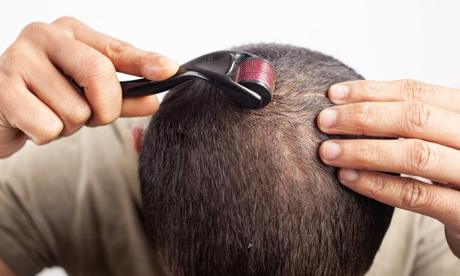 Het dermarollen van het hoofd tegen haaruitval.