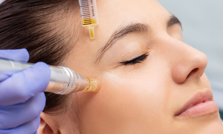 Microneedling met Hyaluronzuur