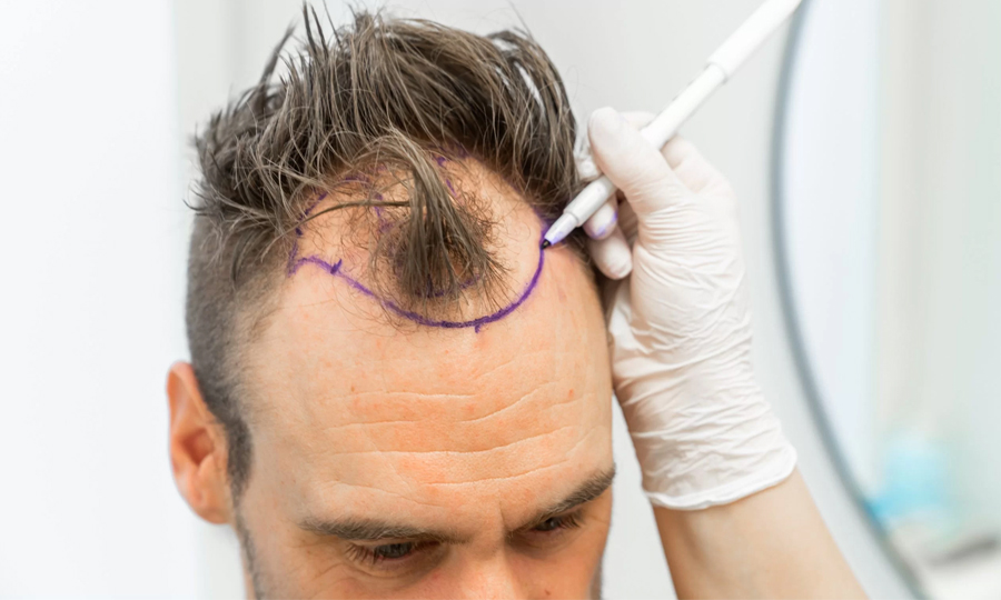 Kan ik haarvezels gebruiken na een haartransplantatie
